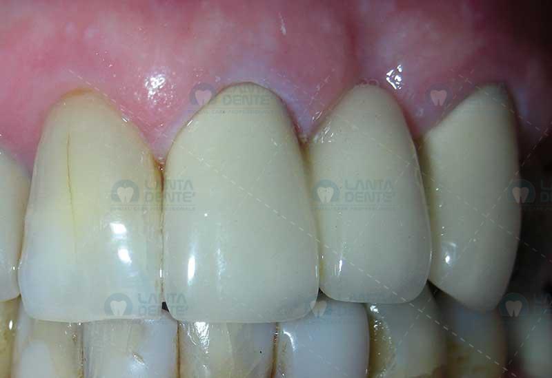 Ceramic Bridges Lanta Dentist