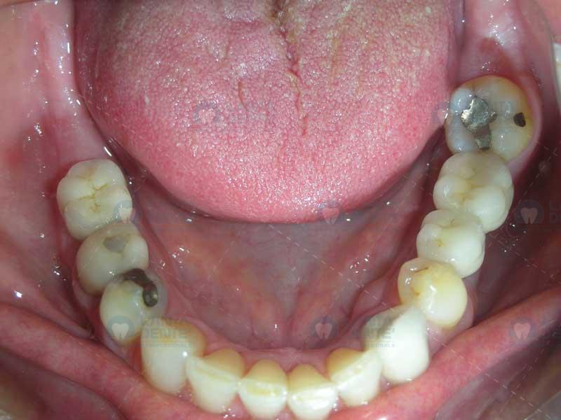 Dental Implants Lanta Dentist