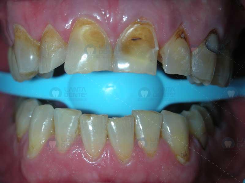 Dental Veneers Lanta Dentist