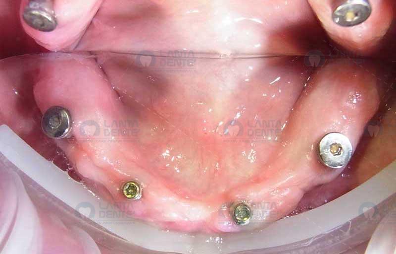 Dental Implants Lanta Dentist