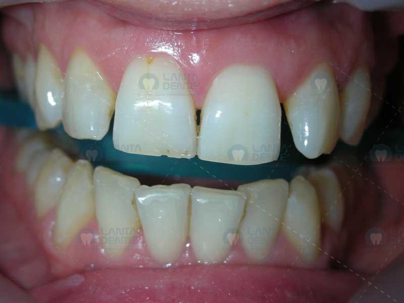 Dental Veneers Lanta Dentist