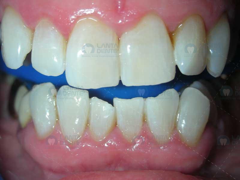 ZOOM Whitening Lanta Dentist