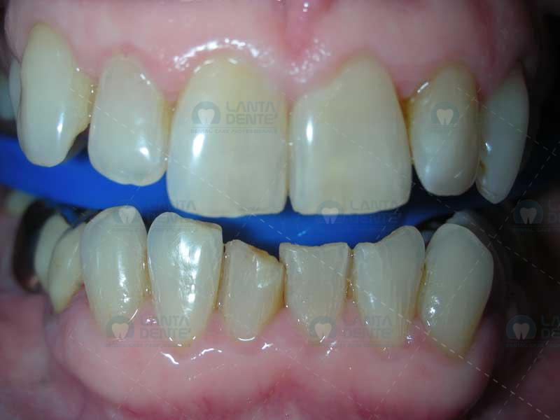 ZOOM Whitening Lanta Dentist