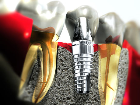 Dental Implants Thailand