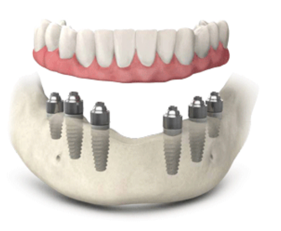 Имплантация зубов all on 6. Имплантация Алл 6 зубов. Протез на 6ти имплантах. Несъёмный протез на 6 импланта х.